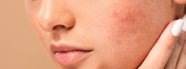 Acido Salicilico: il migliore alleato contro acne e impurità della pelle